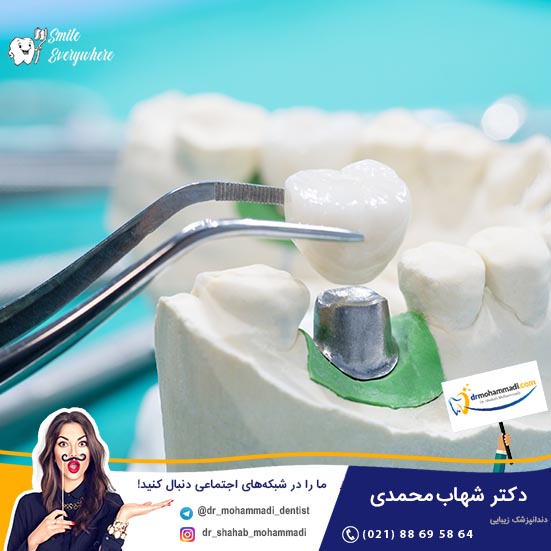 هزینه تقریبی ایمپلنت - کلینیک دندانپزشکی دکتر شهاب محمدی